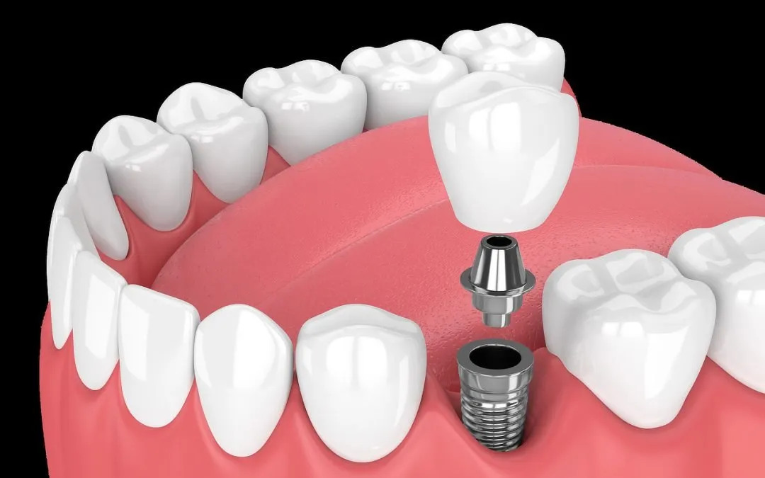 Are Dental Implants Right for Me