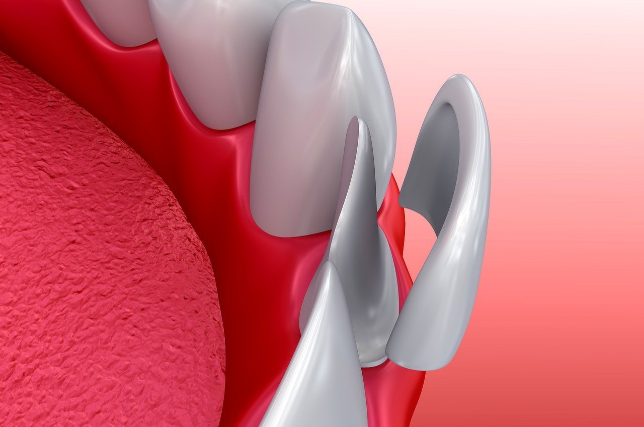 Dental Veneers - York Village Dental