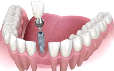 Front Teeth Dental Implants