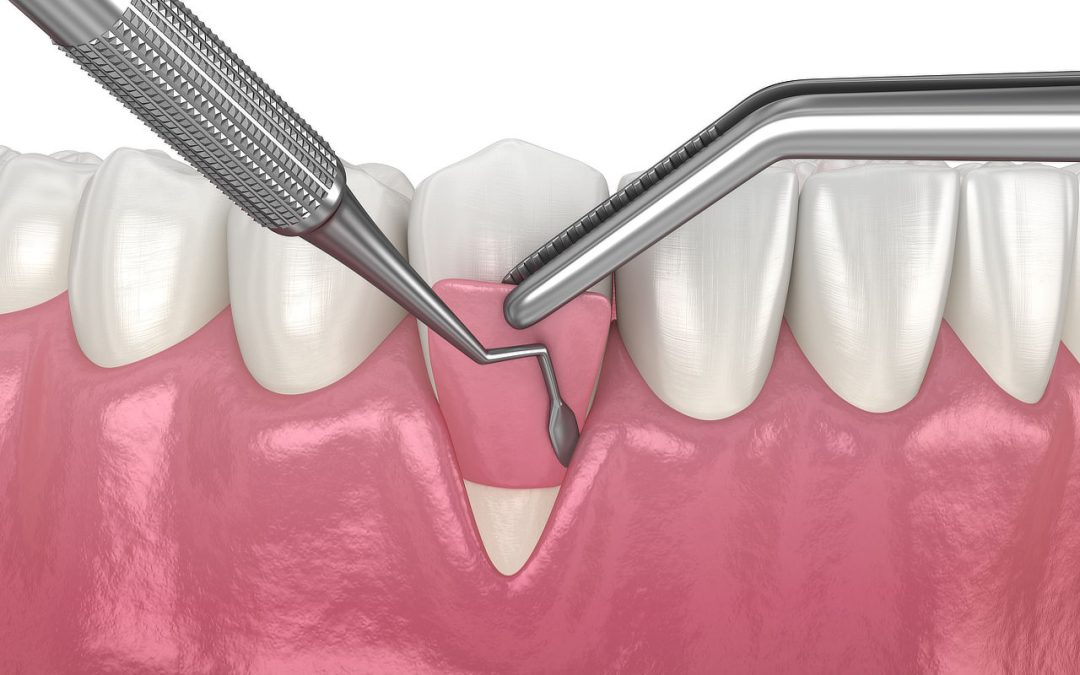 A Patient’s Guide to Gum Disease Treatments