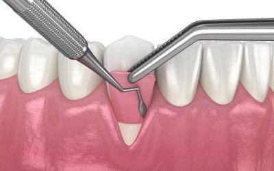 A Patient’s Guide to Gum Disease Treatments
