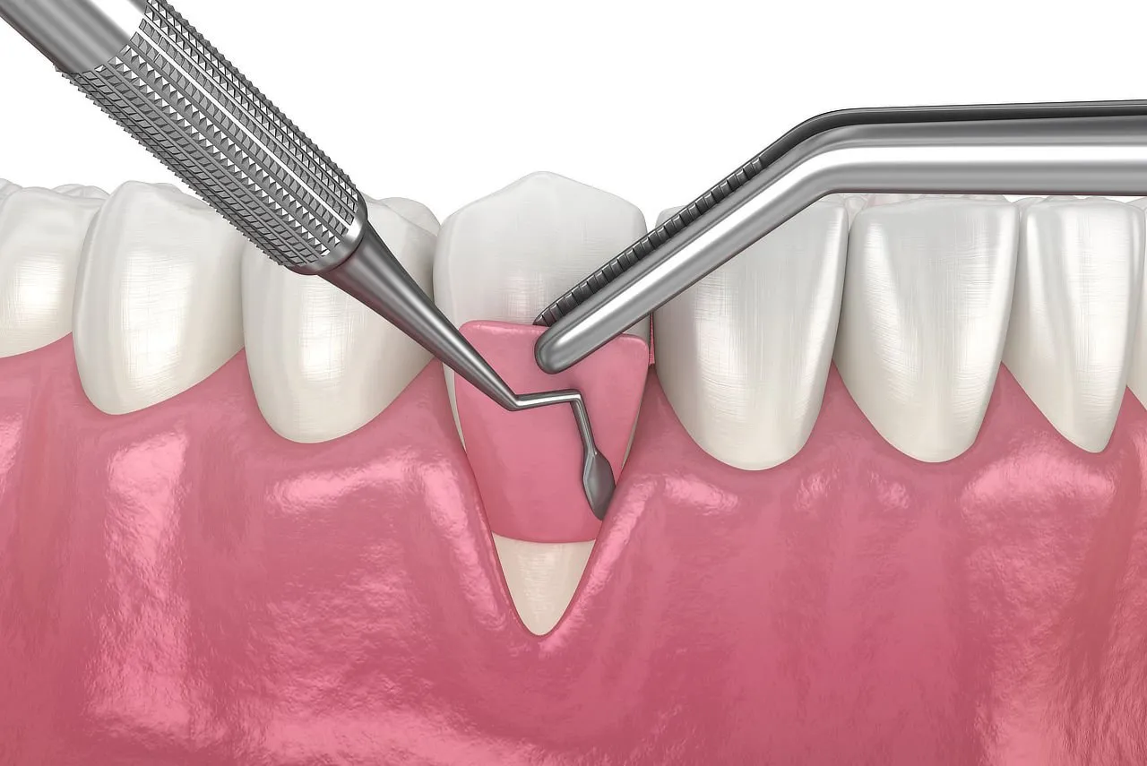 A Patient’s Guide to Gum Disease Treatments