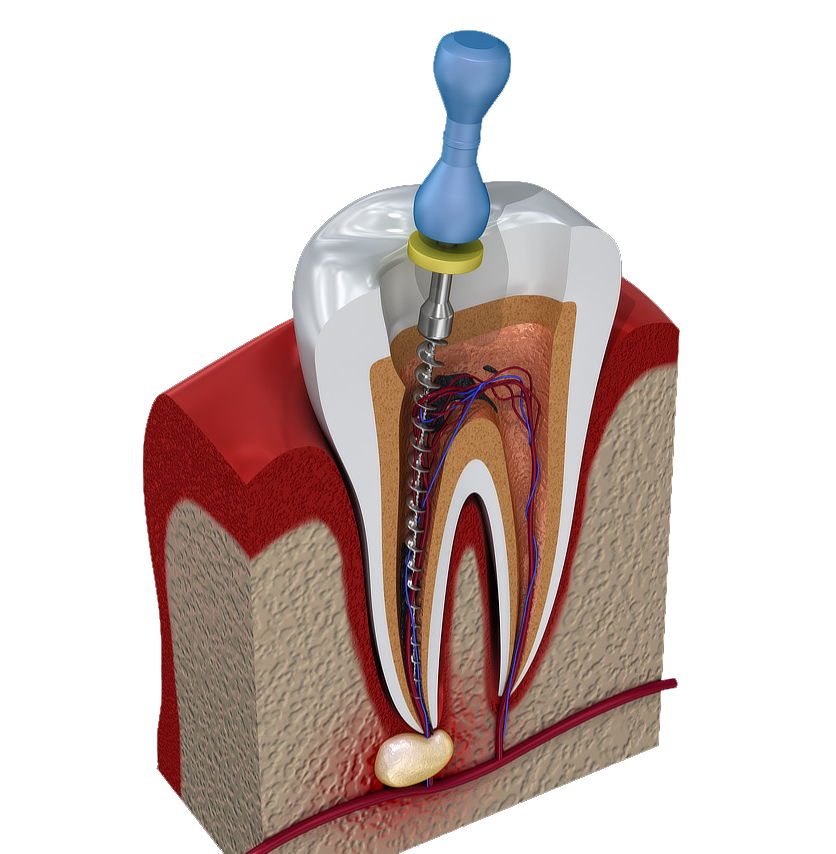 Root-Canal-Procedure-York-Village-Dental-3D